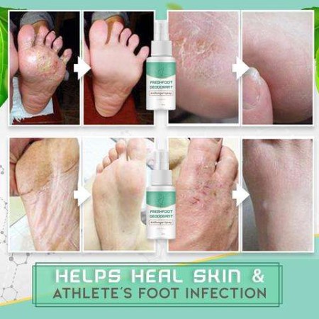 30ml Foot Odor Spray Effective Anti Fungal Spray for Cracked Heel Peeling Blister Repairing Moisturizing Foot Care